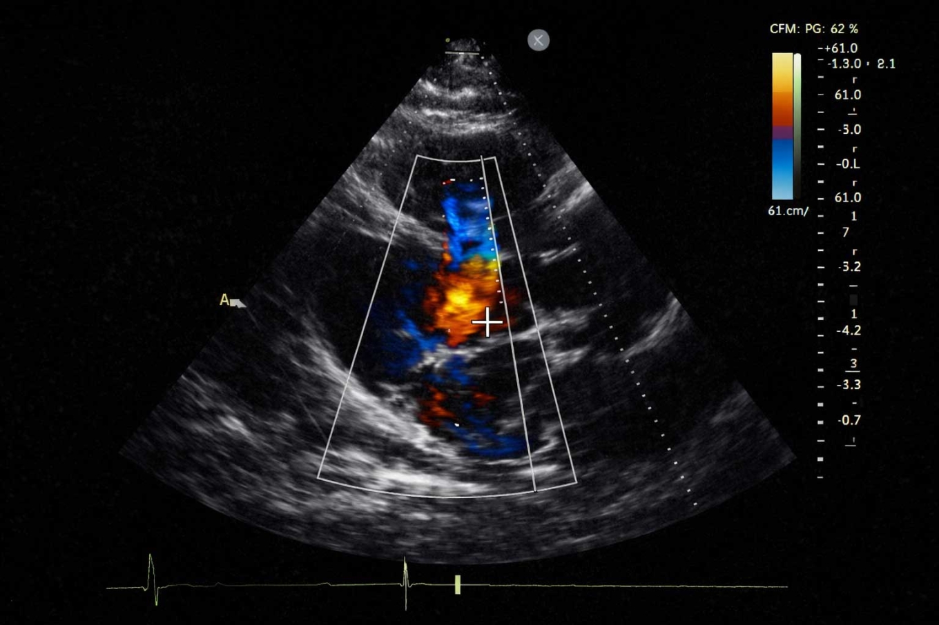 Exame de ecocardiograma sendo realizado para avaliar o funcionamento do coração.