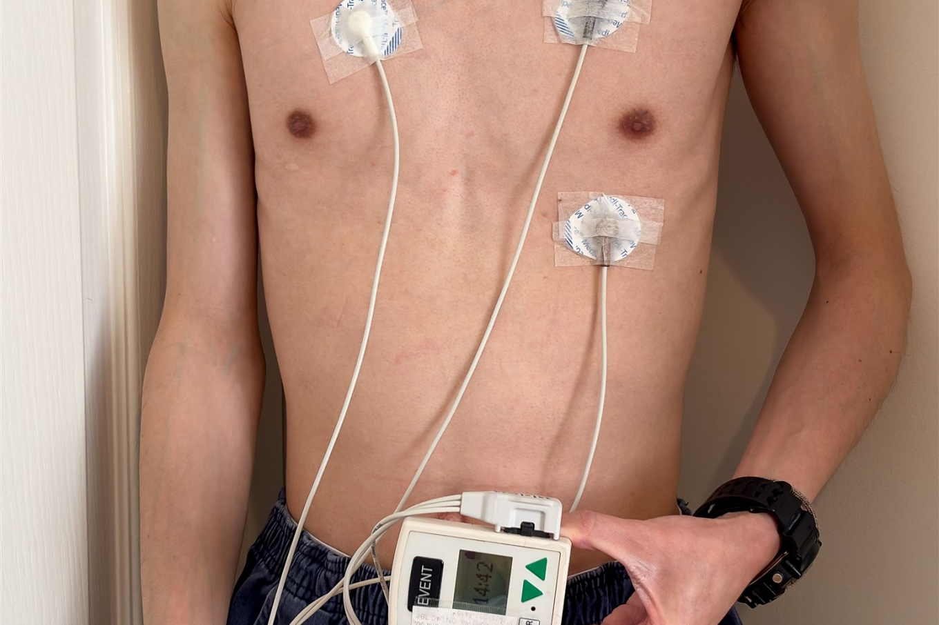 Paciente com três eletrodos adesivos no tórax conectados ao gravador portátil do Holter 24 horas