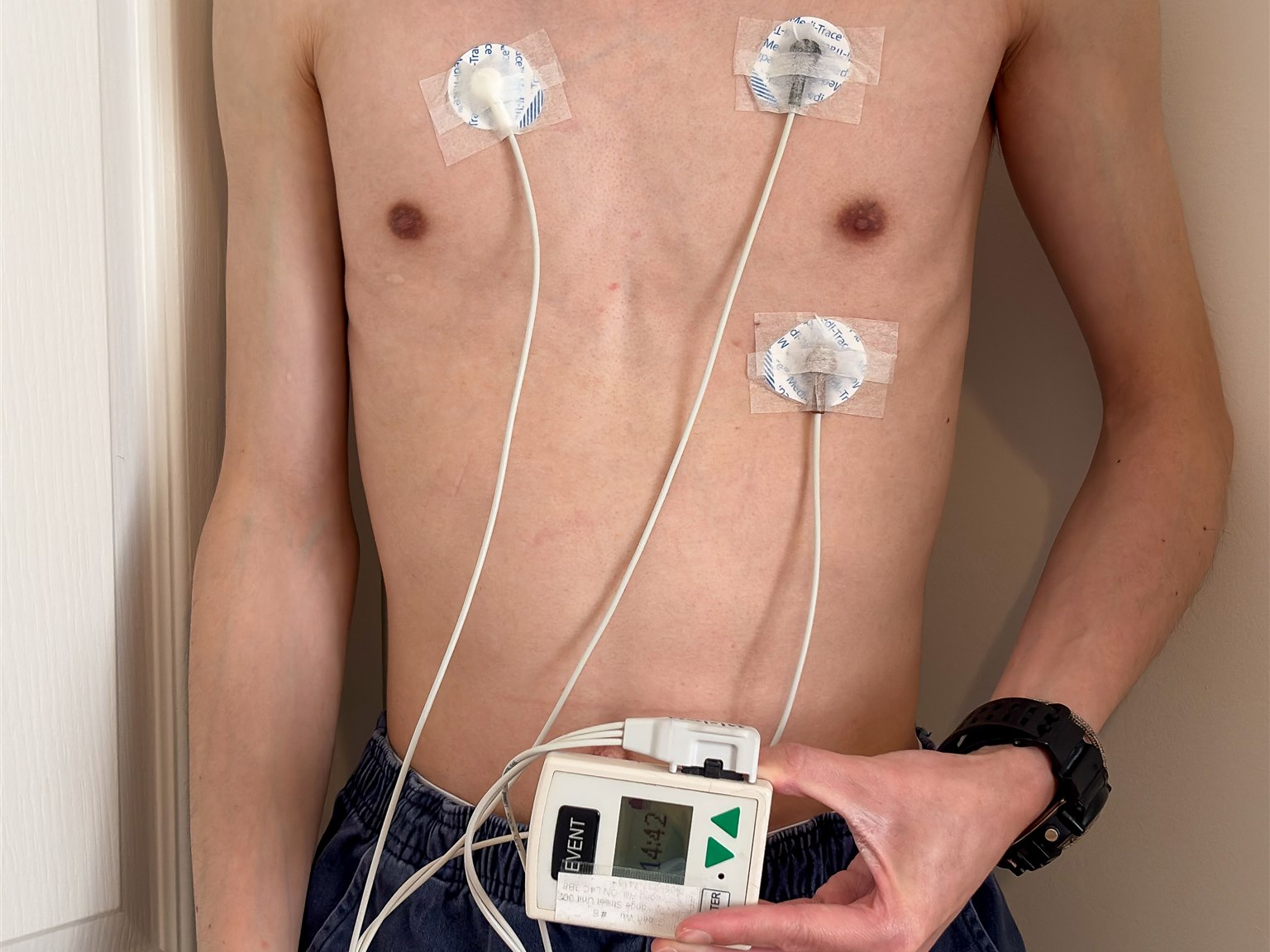 Paciente com três eletrodos adesivos no tórax conectados ao gravador portátil do Holter 24 horas