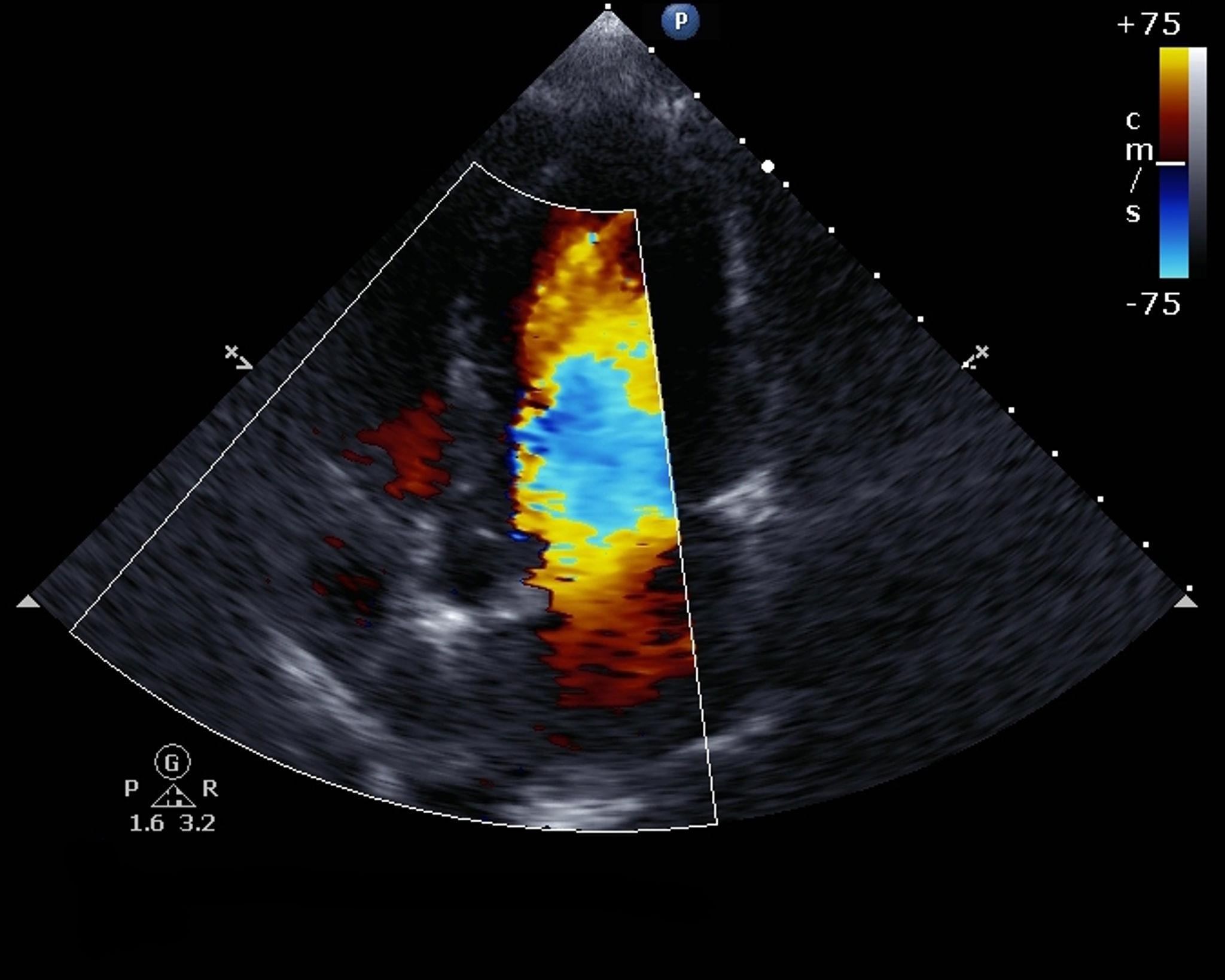 Ecocardiograma com Doppler mostrando fluxo sanguíneo nas válvulas cardíacas